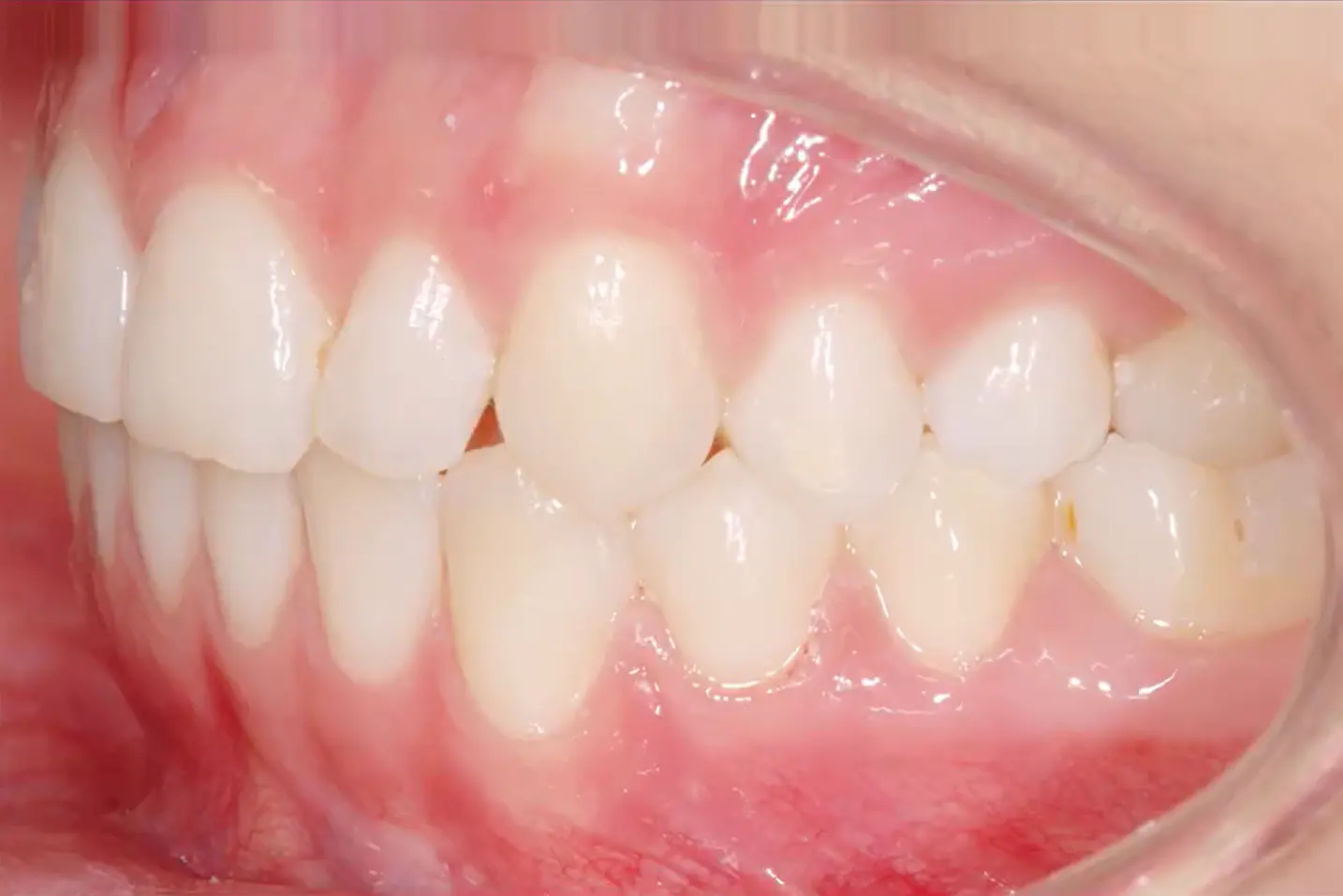 hohe Zahn Ästhetik und gute Kaufunktion durch Harmonie zwischen Kaumuskulatur, Kiefergelenken und Zähnen mit ganzheitlichen KFO Konzept KFO360°