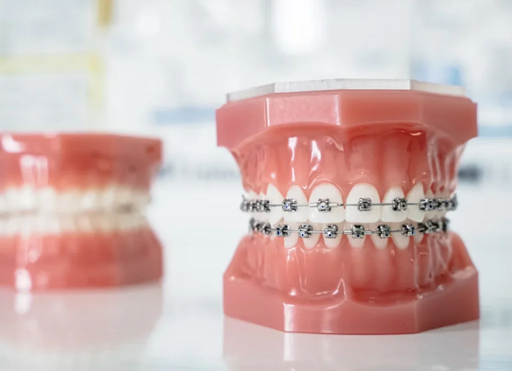 What it the best orthodontic treatment?