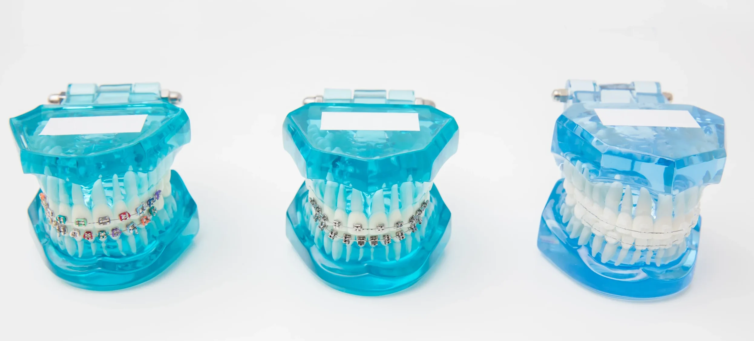 Zahnmodelle mit zahnfarbene Brackets aus Keramik, Metallzahnspange mit modernen Brackets oder älteres Bracketsystem