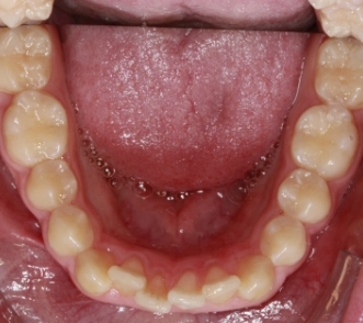 Eng stehende Zähne, sogenannter Erwachsenerengstand oder primärer Engstand