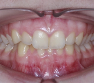 unästhetische Zähne und schiefer Biss vor Fehlbiss Behandlung