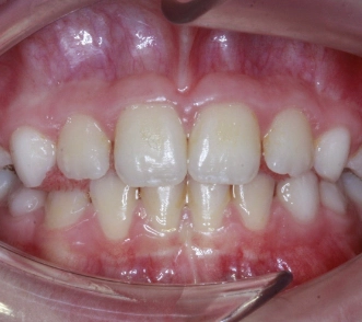 Ergebnis nach Zahnspange Kinder