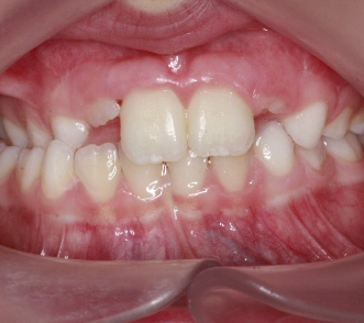 X-Biss und Mittenabweichung des Unterkiefers wegen Zwangsbiss