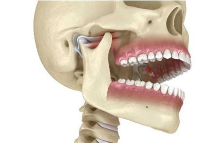 abnormale Kiefergelenksstellung bei CMD Erkrankung und Arthrose Kiefergelenk