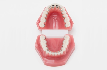 Lingualtechnik für Erwachsene mit kiefergelenksorienterter Zahnkorrektur